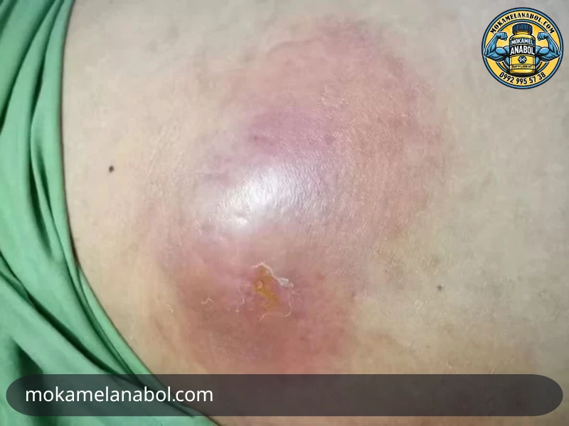 آبسه تزریق وینسترول